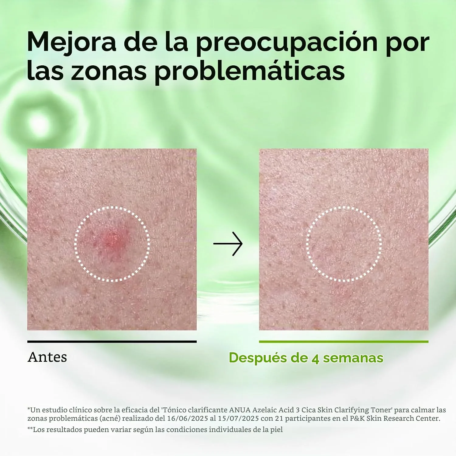 ANUA Azelaic Acid 3 CICA Clarifying Toner, 8.45 fl.oz