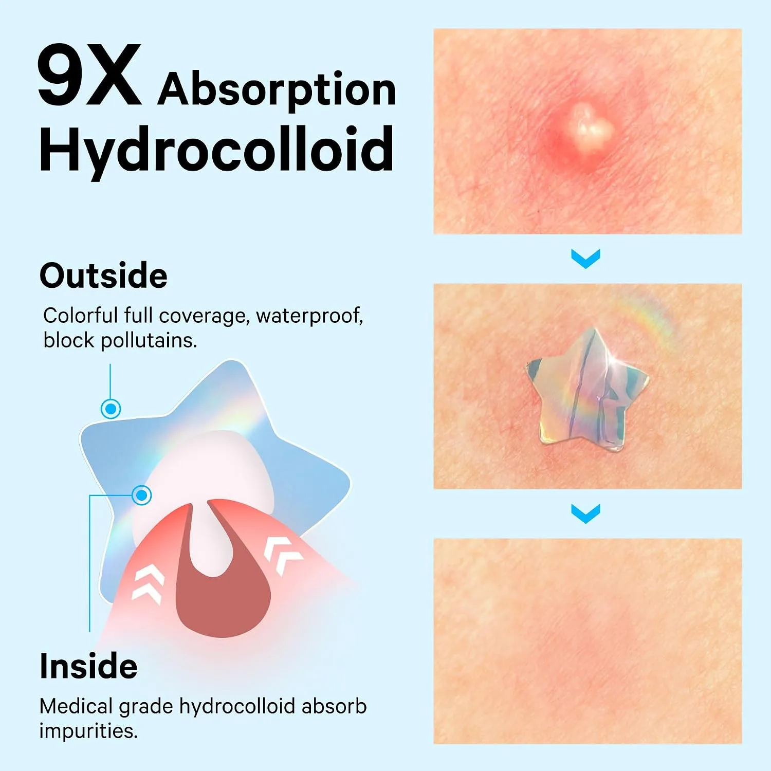 Sosky Hologram Pimple Patches for Face, Hydrocolloid Acne Patches with Salicylic Acid, Cute Star Zit Stickers,Colorful Blemish Covers,48 Count Blue Cloud Butterfly
