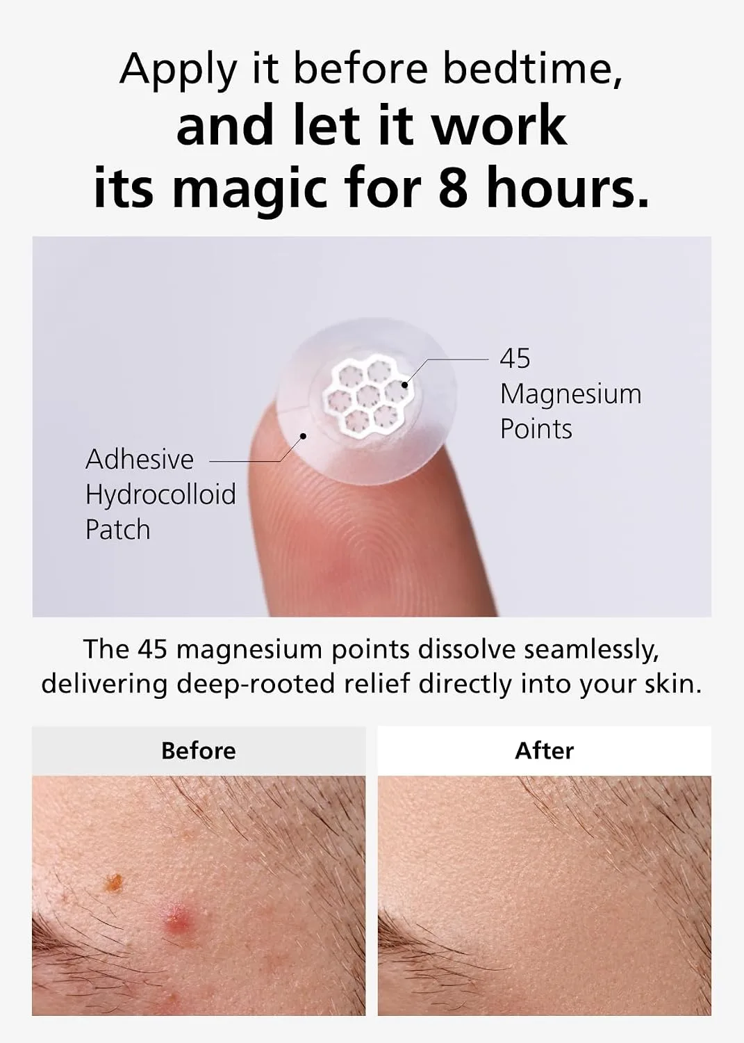 EasyDerm Quick Microdart Magnesium Pimple Patch 20ea - Cica Ampoule&Tweezer