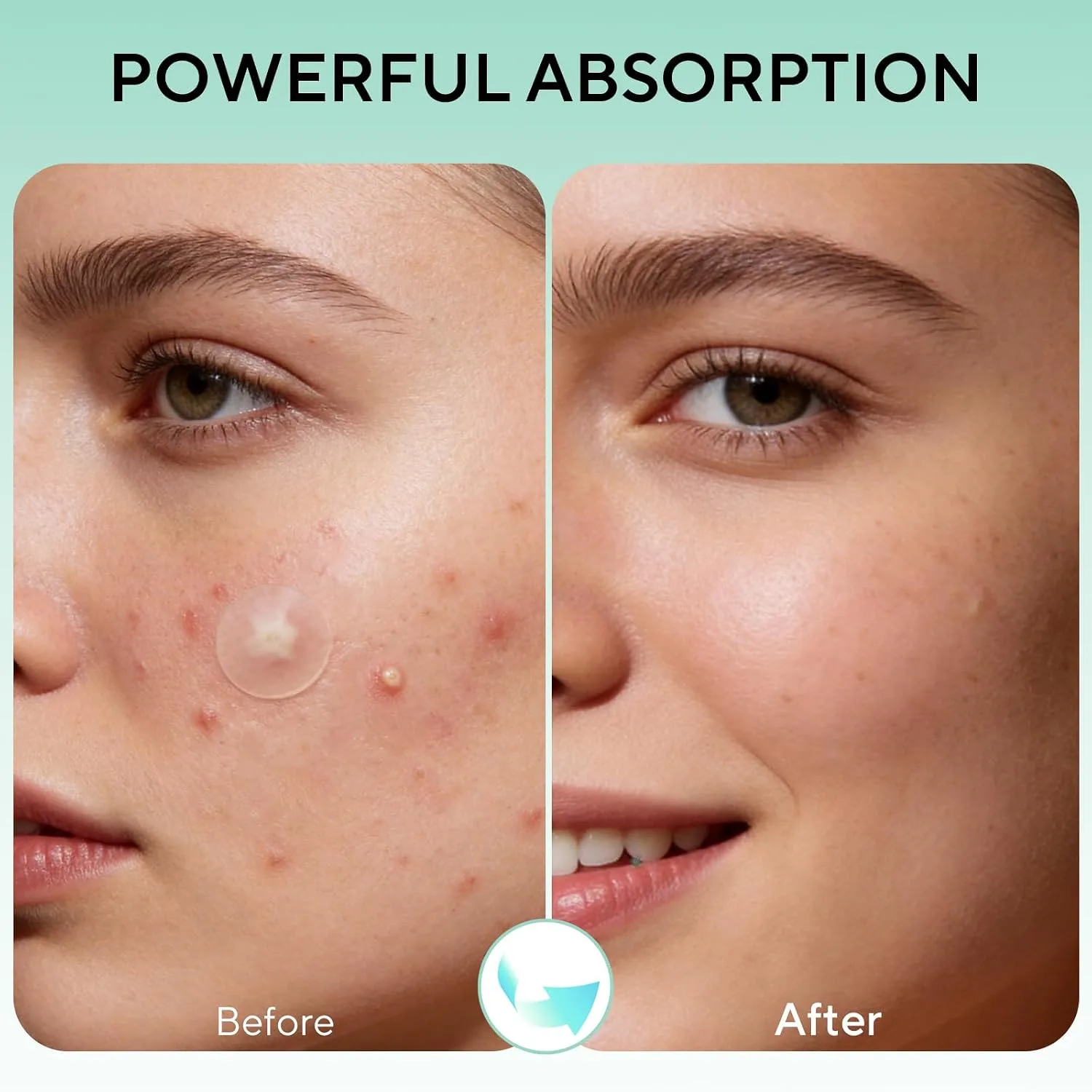 QUSTERE 580 Count Pimple Patches for Face, Large Hydrocolloid Acne Patches Stickers Bandages, Blemishes Zit Breakouts for Cheeks, Forehead, Chin, Nose for Full Face & Body | 7 Sizes | 4 Shapes