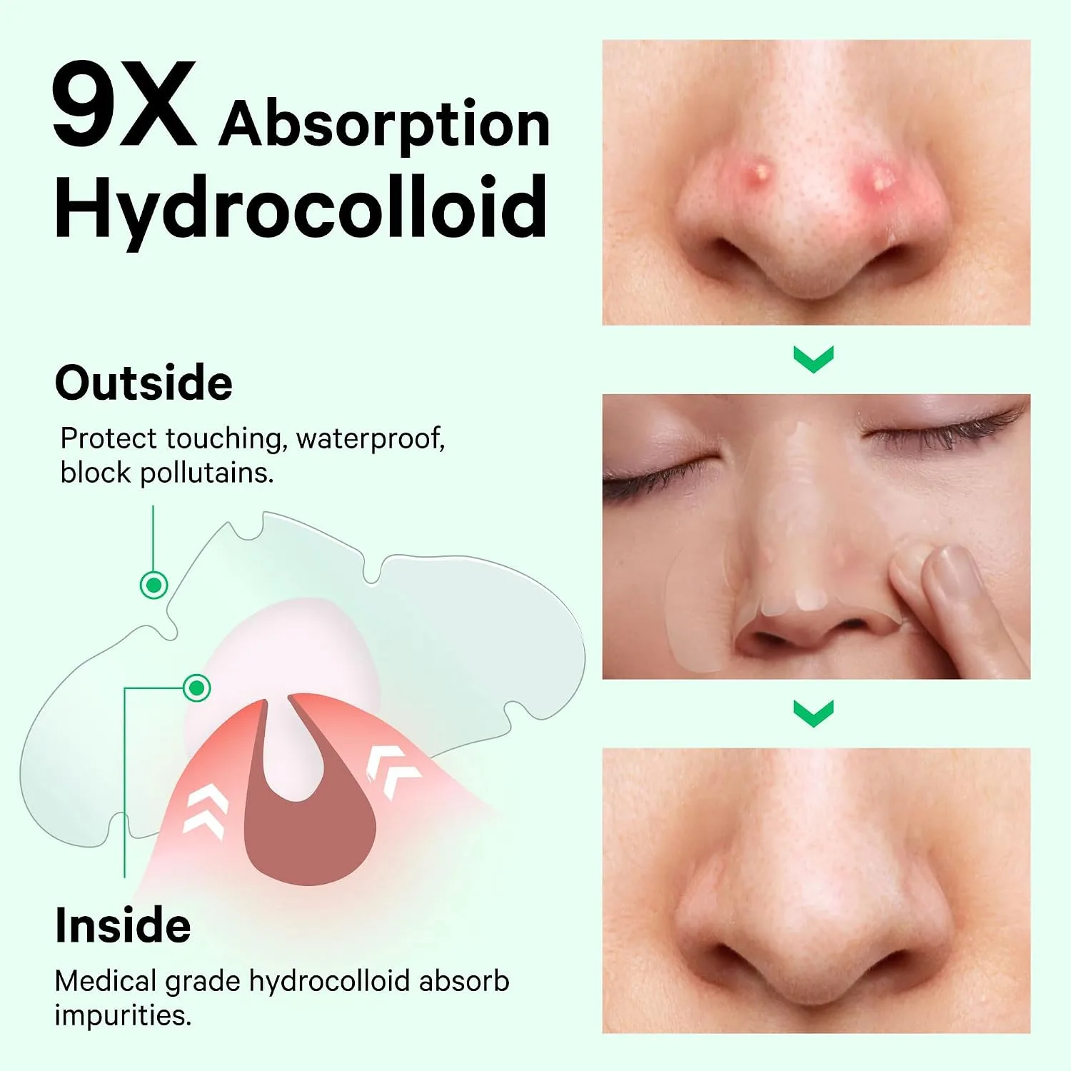 Sosky Nose Pimple Patches, Large Hydrocolloid Nose Pore Strips for Blackheads, Overnight Blackhead Remover Pore Strips, Flexible & Painless Pimple Stickers to Absorb Acne Gunk, 14 Count