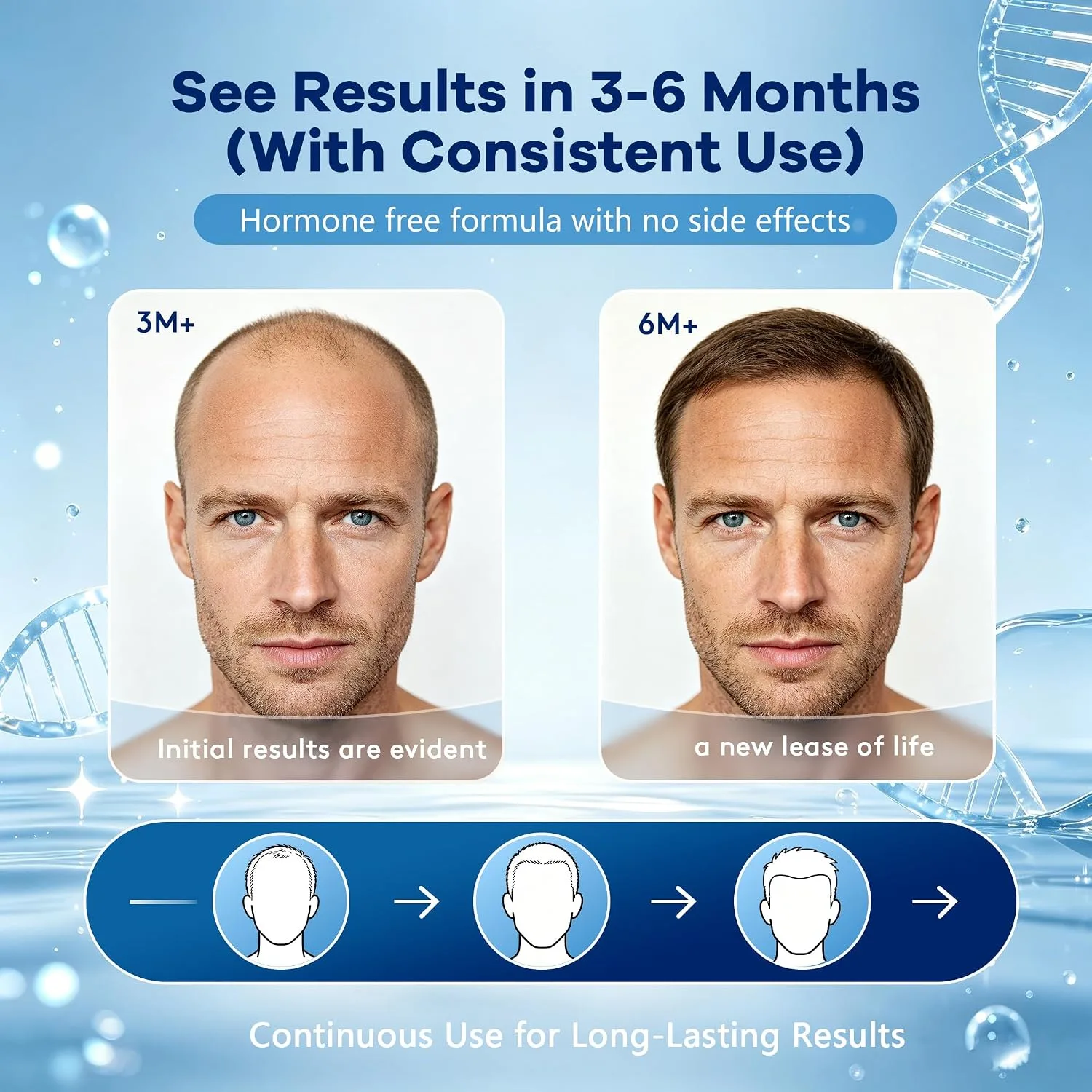 Men's 5% Topical Minoxidil Aerosol Foam Unscented, Biotin Infused Hair Beard Growth Treatment for Thicker Fuller Hair, Comparable to Rogaine Active Ingredient, 8.44oz 4 Month Supply