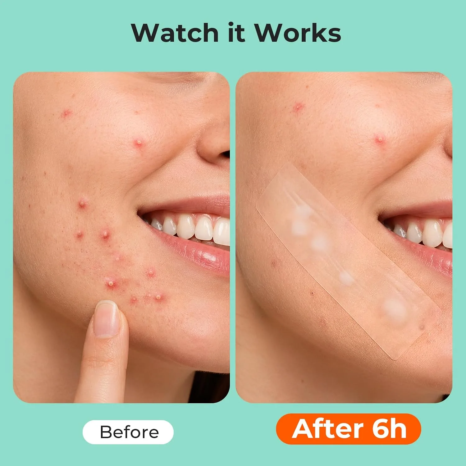 TKTK Large Hydrocolloid Pimple Patches for Acne Breakouts, 4 Big Sizes