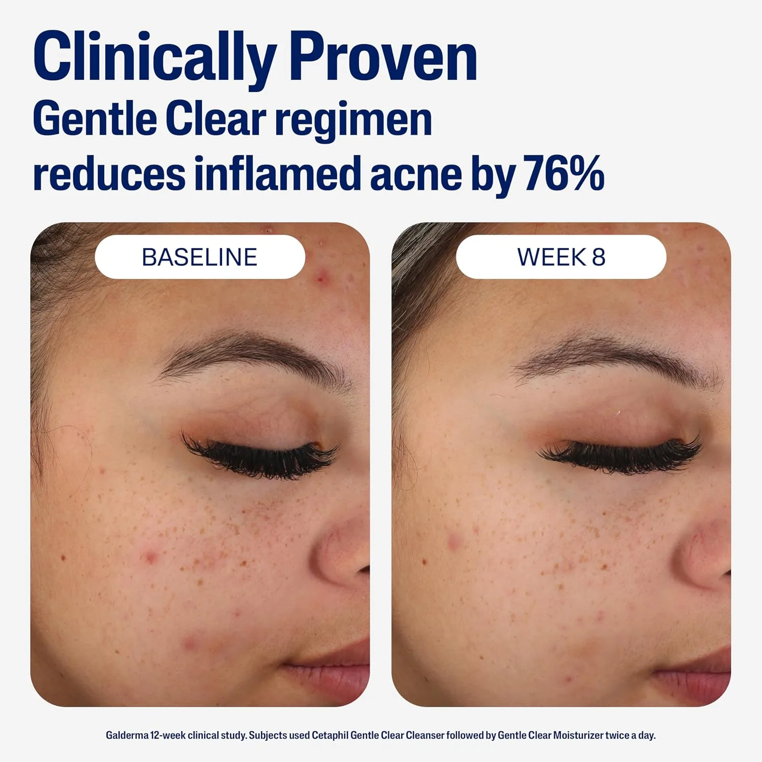 Cetaphil Gentle Clear Mattifying Acne Face Moisturizer, Salicylic Acid, 3oz