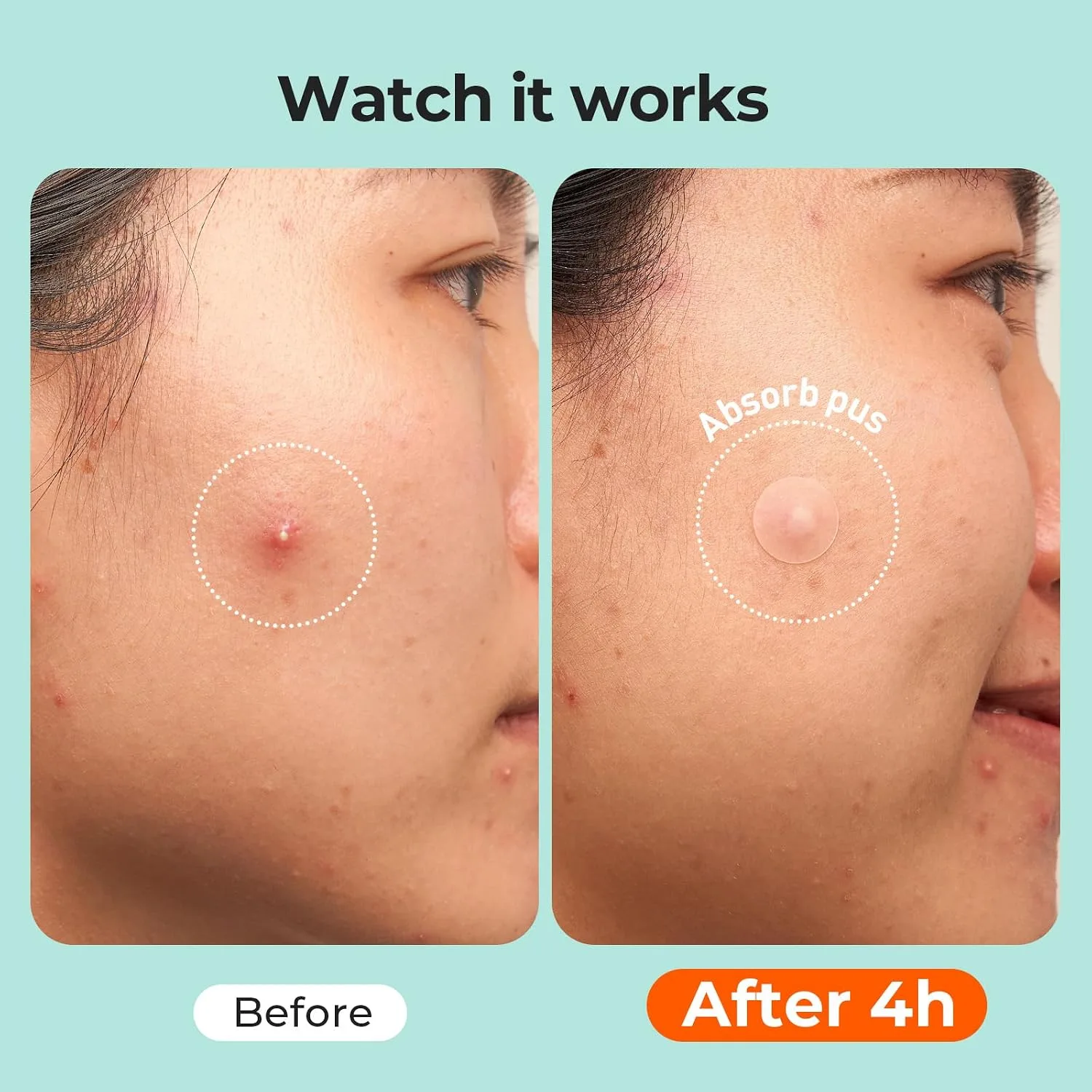 TKTK 443 Count Pimple Patches for Face, Hydrocolloid Acne Cover Patch Bulk