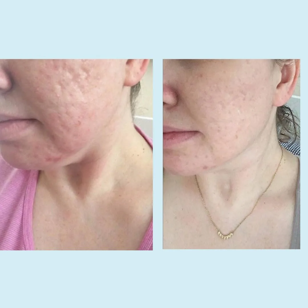 Glycolic Acid 50% Gel Peel - Enhanced with Retinol & Green Tea Extract (Professional Skin Peel)1 ounce