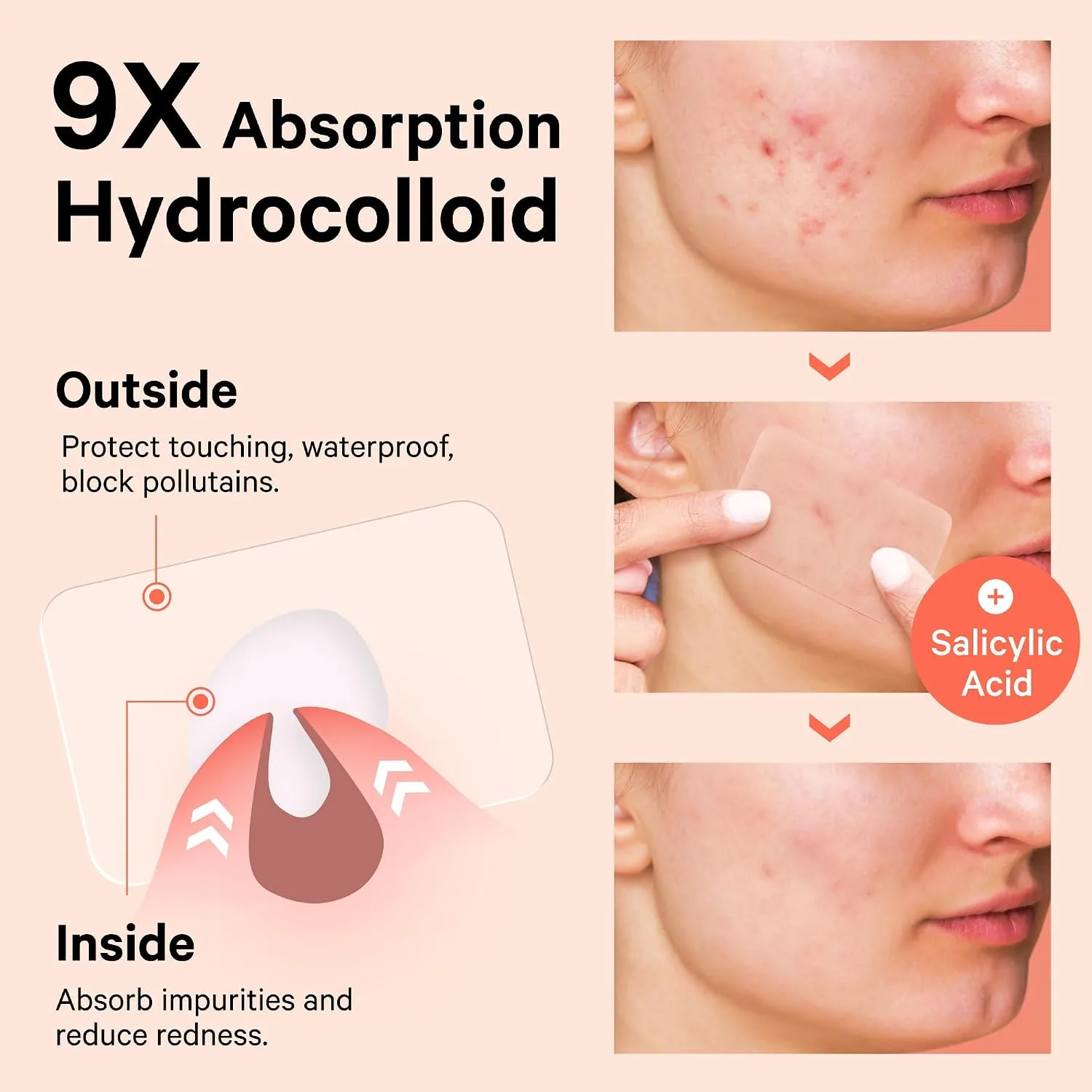 Sosky Large Pimple Patches XL Hydrocolloid Acne Patches for Face & Body Cystic Pimple & Zit Patch for Nose Chin Back, Bacne & Breakouts Vegan Cruelty-Free（8 Count）