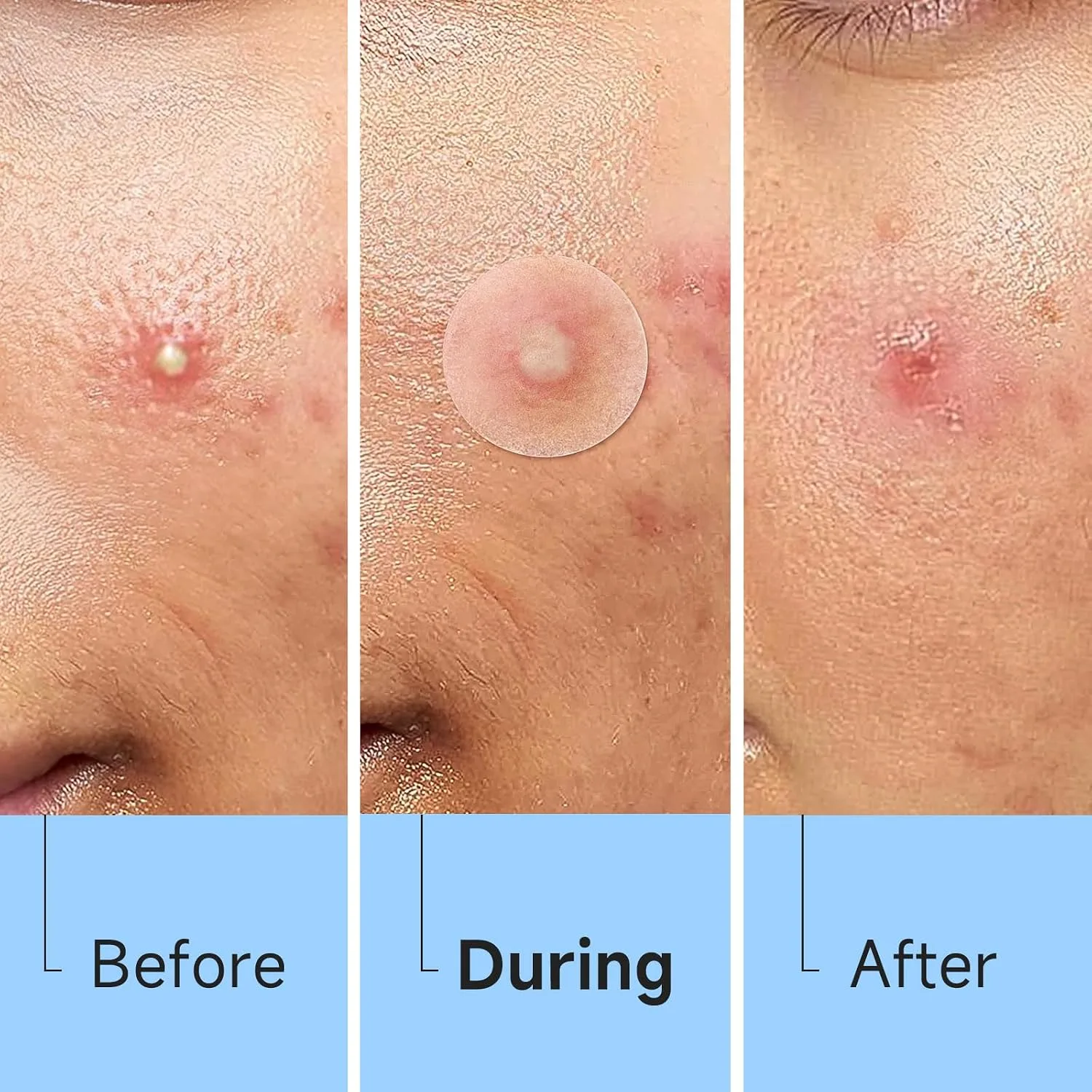 840 Counts 4 Sizes Pimple Patches for Face