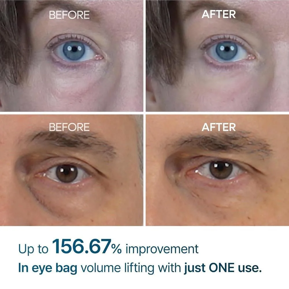 Crema para Bolsas de Ojos Dr.Melaxin Eyephalt, reducción de hinchazón y ojeras, mejora la elasticidad con EGF y Bio-Spicule