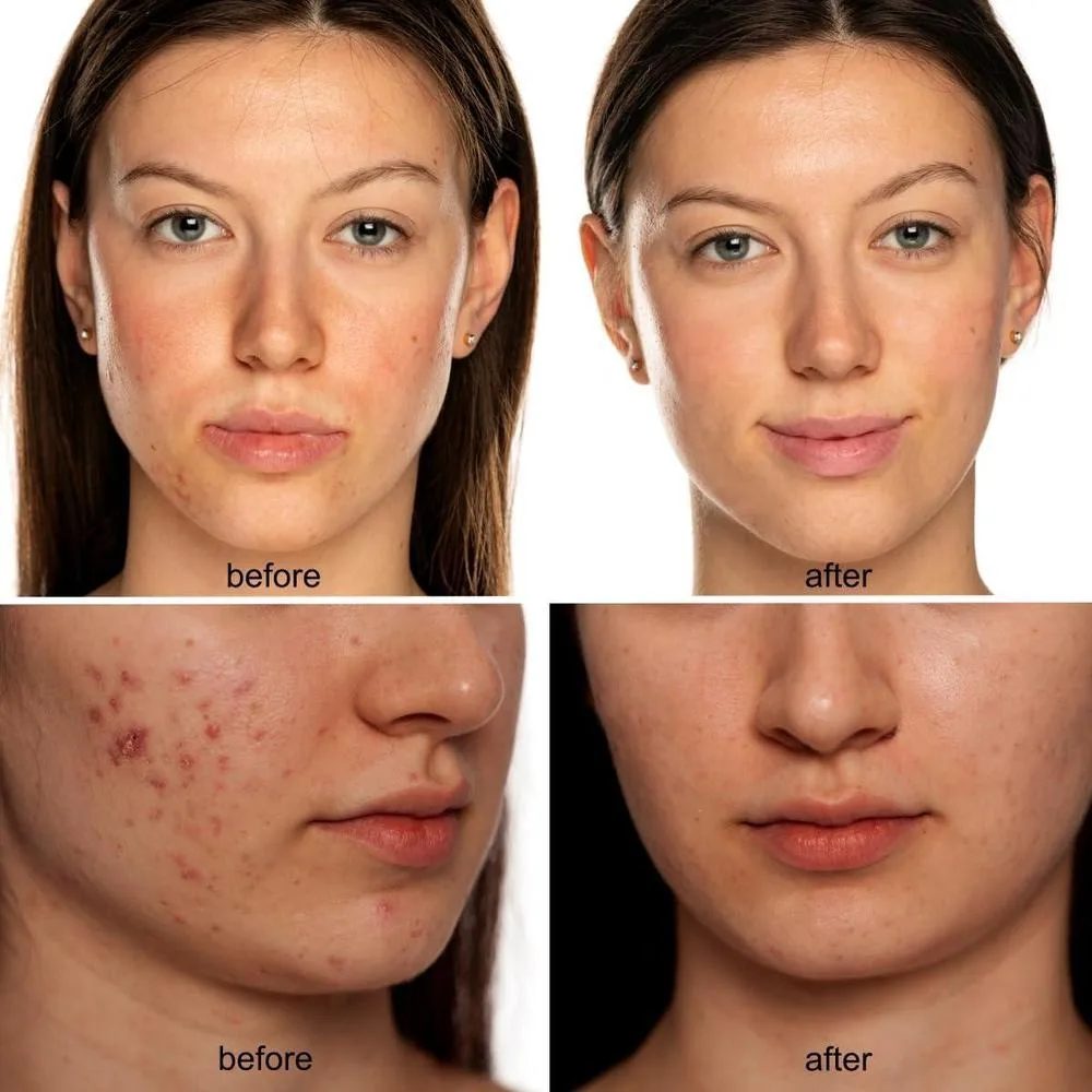 Máscara LED de belleza con terapia de luz roja e infrarroja para arrugas, luz azul para acné y tecnología de longitud de onda múltiple